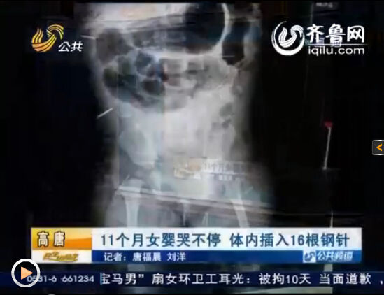 聊城:11個(gè)月女?huà)塍w內(nèi)被插入16根鋼針